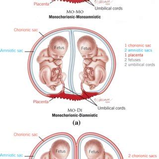 a Monochorionic-monoamniotic twins (MCMA, shown in the top image) have ...