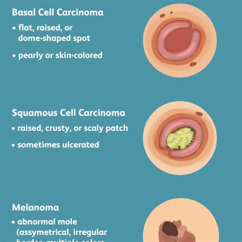 Malignant Melanoma Symptoms And Signs - Doctor Heck