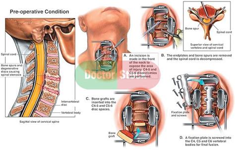 Severe Cervical Stenosis with Double Level Cervical Fusion | Doctor ...