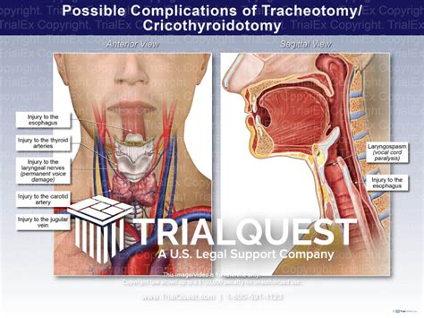 Possible Complications of Tracheotomy/ Cricothyroidotomy - Trial...