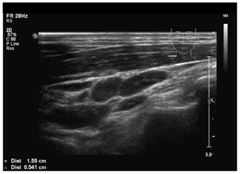 Lymphoma Neck Lymph Nodes