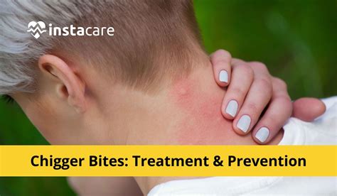 Chigger Bites Pictures, Symptoms, Causes, Treatment, And Prevention