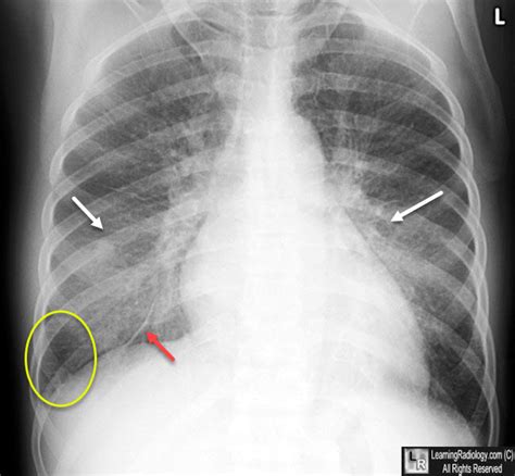 Learning Radiology - Congestive Heart Failure, Pulmonary Edema