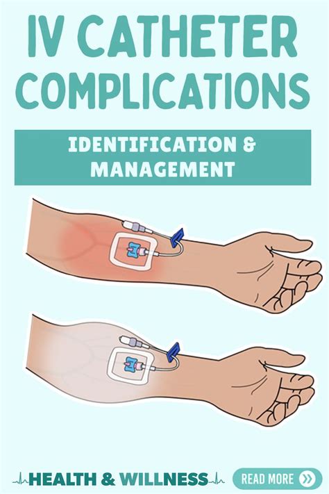 IV Infiltration and other IV Catheter Complications: Identification and ...