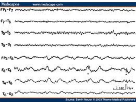 Abnormal EEG patterns