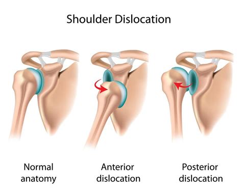 Shoulder Instability - Anatomy & Causes (Video) - Jeffrey H. Berg, M.D.