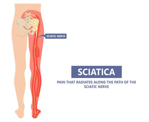 Best Sciatica Treatment in Cary, NC | Shiva Physical Therapy