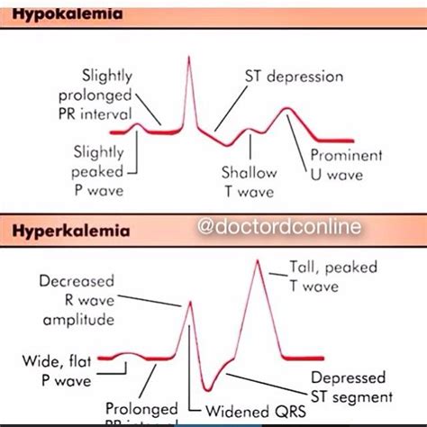 Doctor @doctordconline Hypokalemia vs H... Instagram | Hyperkalemia ...