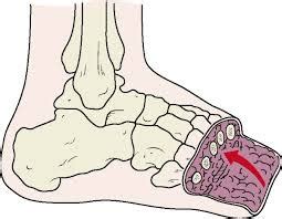 Transmetatarsal amputation Pictures, Rehabilitation, Recovery ...