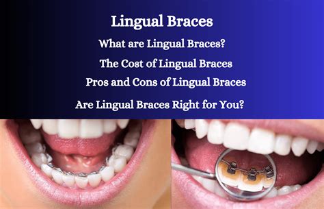 Lingual Braces: Cost, Comfort, Pros and Cons - Oral Health Line