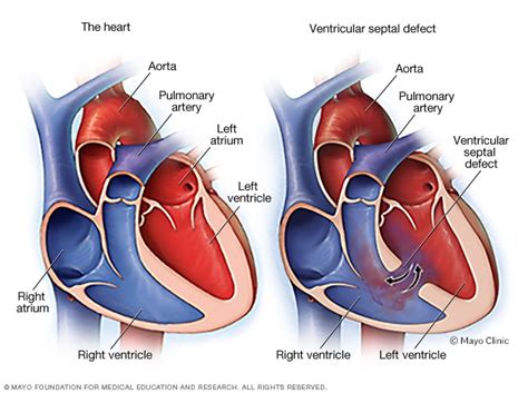 Ventricular septal defect - Mayo Clinic