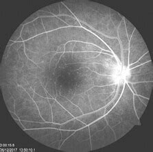 Fundus Fluorescein Angiography - Procedure, After care | Neoretina