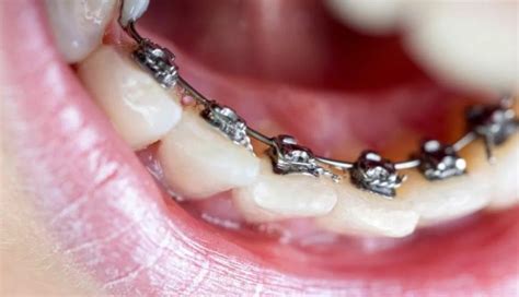 What Are Lingual Braces? Pros & Cons | Healthy Body and Tips