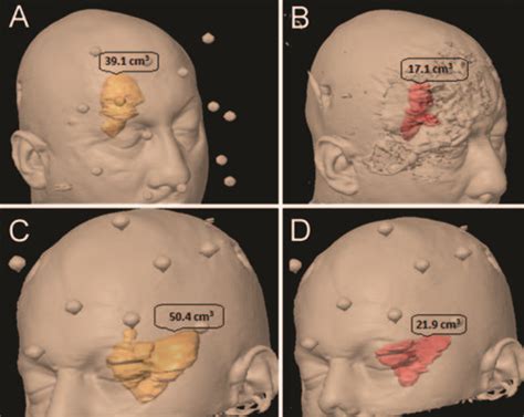 Microsurgical resection of extensive craniopharyngiomas using a ...