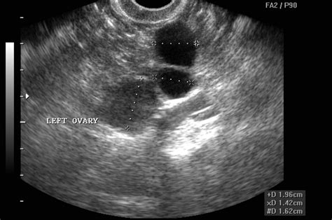 Ovarian Cancer Tumor Ultrasound