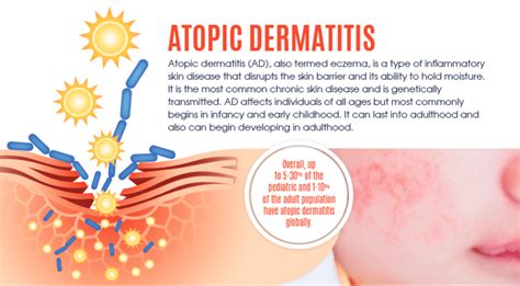 Atopic Dermatitis - Eczema Infographic - Interesting Facts 2019