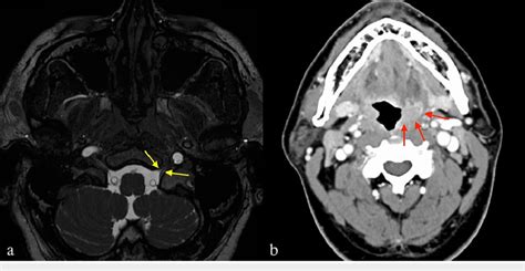 MRI and contrast-enhanced computed tomography (CECT) images at the ...