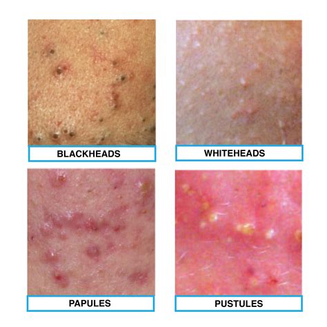 The four types of acne: blackheads, whiteheads, papule and pustules ...