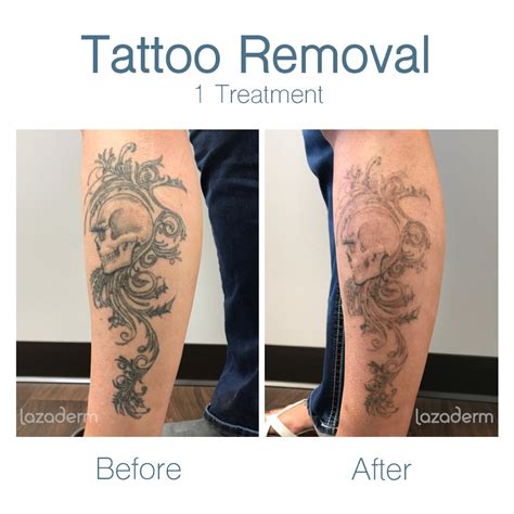 Laser Tattoo Removal in Chandler, AZ | Free Consultation — Lazaderm ...