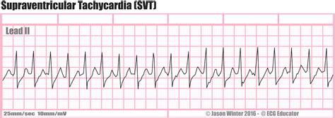 ECG Educator Blog : Six Second ECG Rhythm Strips