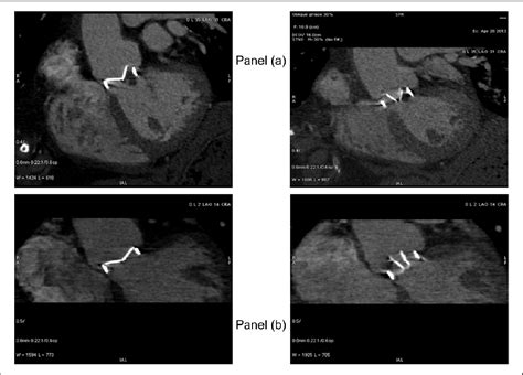 Figure 1 from Transient thrombosis of mechanical bileaflet aortic valve ...