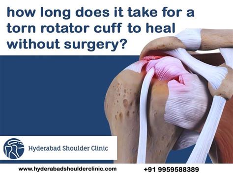 How long does it take for a torn rotator cuff to heal without surgery ...