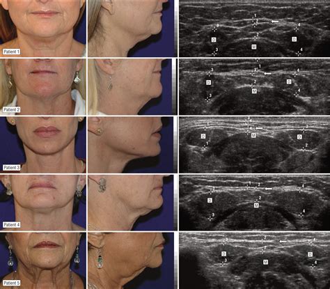 The Utility of Ultrasound in the Evaluation of Submental Fullness in ...