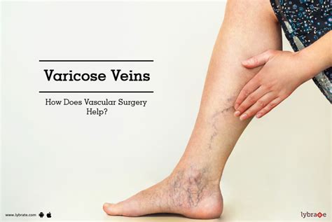 Varicose Veins - How Does Vascular Surgery Help? - By Dr. Ramakrishna ...