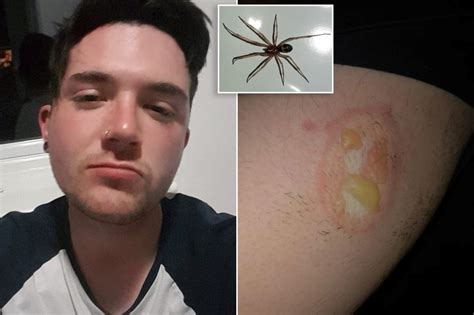 Spider leaves man with flesh-eating wound that won't heal