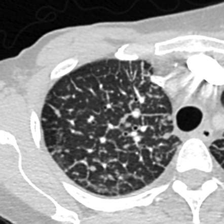 Perilymphatic lung nodules | Radiology Reference Article | Radiopaedia.org