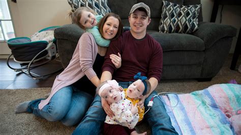 Conjoined twins successfully separated in Michigan