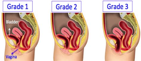 Pessary for uterine prolapse, pessary fitting, insertion, care, removal ...