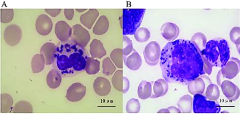 Abnormal intracytoplasmic giant granule in granular leukocytes in ...