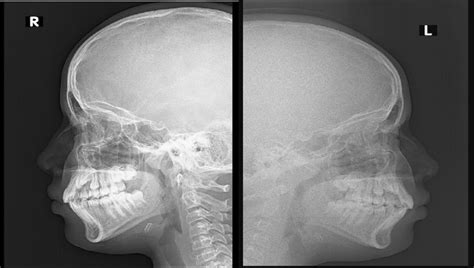 X-ray nasal bone images showing fracture of nasal bone | Download ...