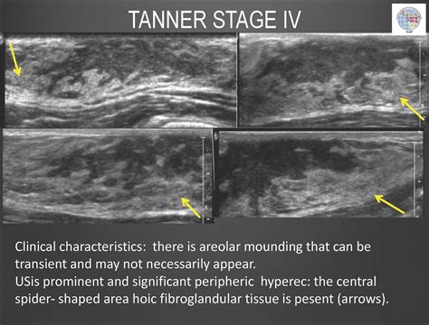 Breast Development - Tanner Stage IV - Significant peripheral ...