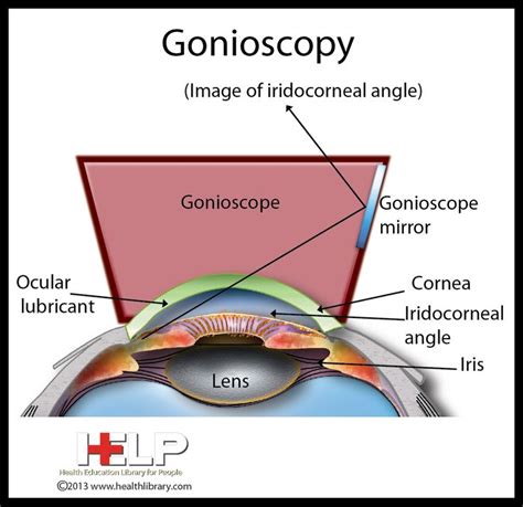 Gonioscopy | Eye | Pinterest