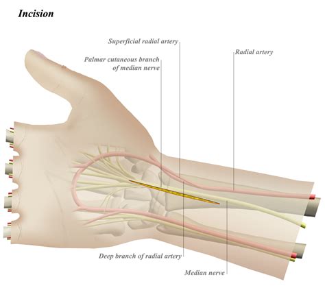 Volar Approach to Wrist - Approaches - Orthobullets