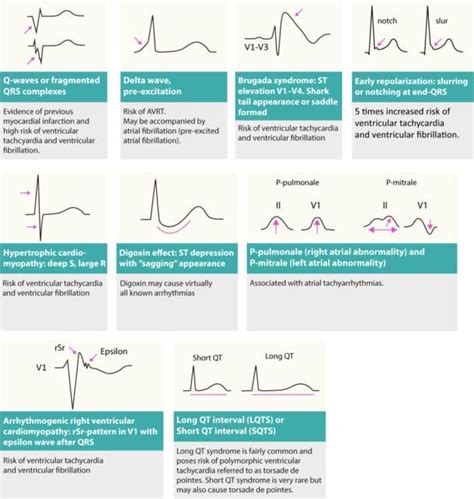 Figure 3. Changes on resting ECG that may reveal cause of arrhythmias ...