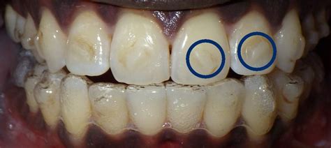 What Are Invisalign Attachments? Everything You Need to Know ...