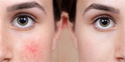 How Do You Get Rid of Broken Blood Vessels on Your Face? | HealthNews