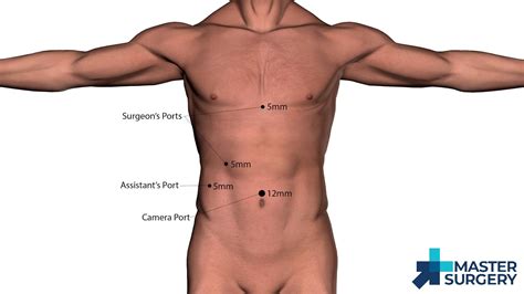 Laparoscopic Cholecystectomy – Master Surgery