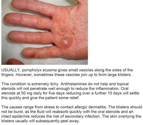 Consultations in Dermatology: Pompholyx eczema