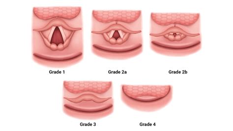 Pediatric Direct Laryngoscopy and Tracheal Intubation - OpenAnesthesia