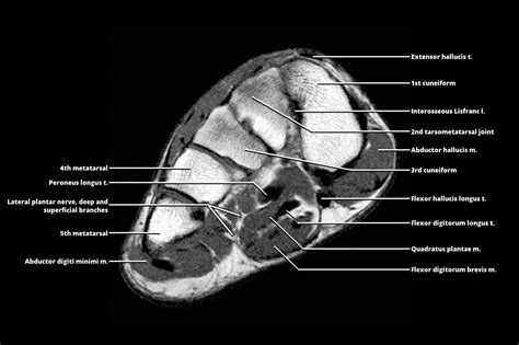 Mri Plantar Foot Anatomy Muscles