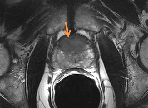 Biparametric MRI May Suffice for Prostate Cancer Detection - Renal and ...