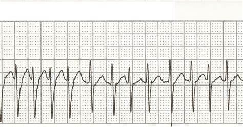 All Ekg Rhythm Strips