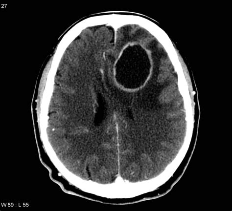 Cerebraler Abzess - DocCheck