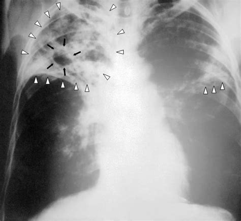 Lung cavity - Wikipedia