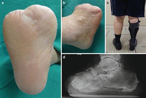 Transmetatarsal and Lisfranc Amputation | Musculoskeletal Key