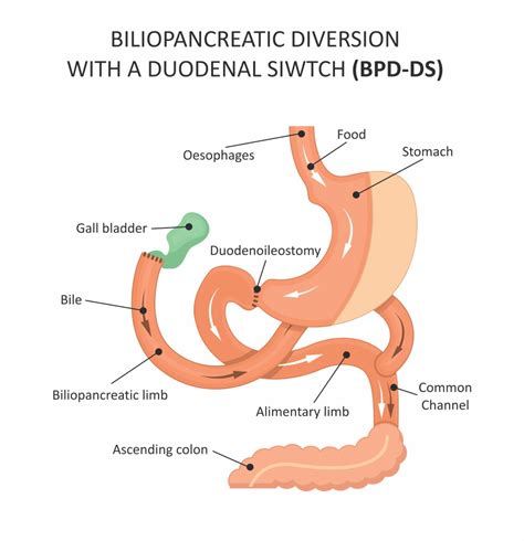 Duodenal Switch Surgery | Lose My Weight and Keep It Off | BMCC